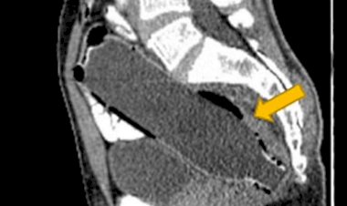 Esposa leva marido “constipado” ao hospital e médicos encontram garrafa presa no intestino