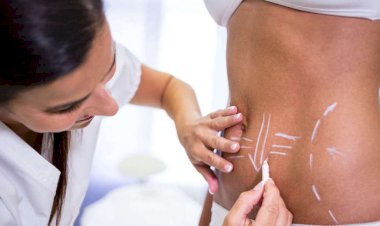 Abdominoplastia e lipoaspiração não são tratamentos para perder peso, alerta especialista